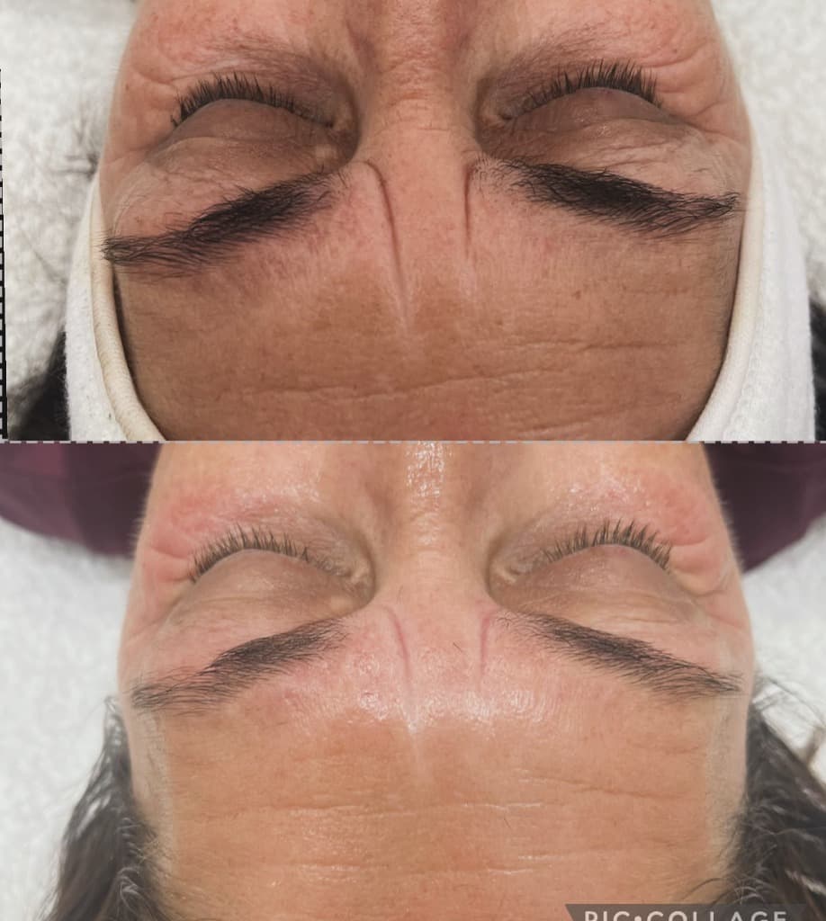 Resultado de Tratamientos faciales