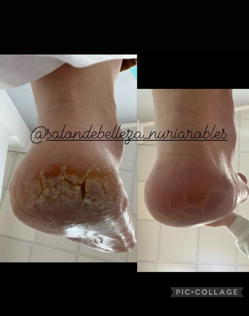 Resultado de Pedicura
